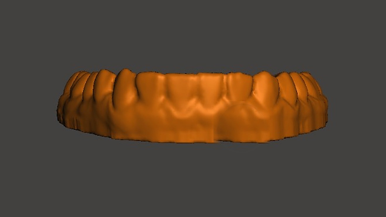 Escaneo intraoral — modelo dental