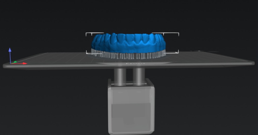 Escaneo intraoral 3D